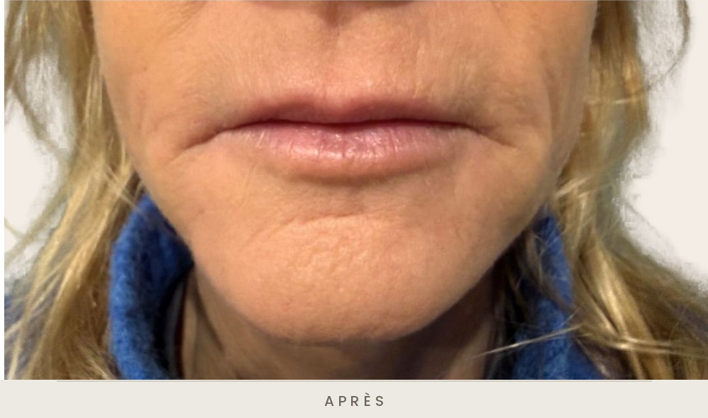 Injection d'acide hyaluronique des sillons nasogéniens et des plis d'amertume, vue de face après l'injection — Dr David Ganon, chirurgien plasticien à Paris