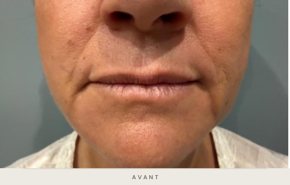 Injection d'acide hyaluronique des sillons nasogéniens et des plis d'amertume, vue de face avant l'injection — Dr David Ganon, chirurgien plasticien à Paris