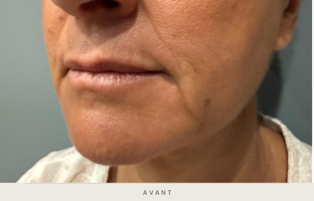 Injection d'acide hyaluronique des sillons nasogéniens et des plis d'amertume, trois quarts gauche avant l'injection — Dr David Ganon, chirurgien plasticien à Paris