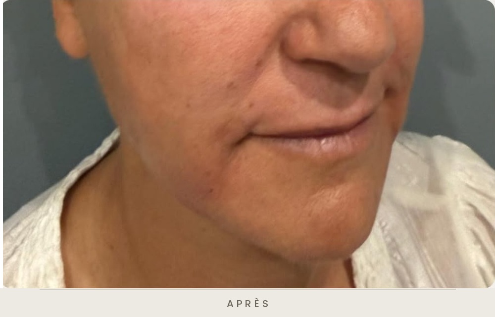 Injection d'acide hyaluronique des sillons nasogéniens et des plis d'amertume, trois quarts droit après l'injection — Dr David Ganon, chirurgien plasticien à Paris