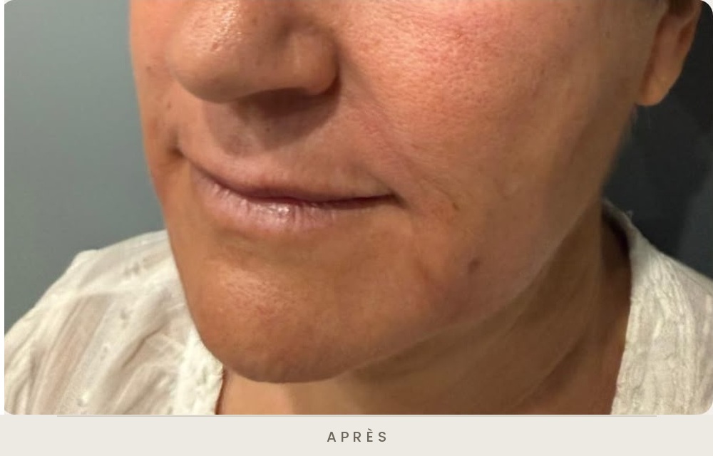 Injection d'acide hyaluronique des sillons nasogéniens et des plis d'amertume, trois quarts gauche après l'injection — Dr David Ganon, chirurgien plasticien à Paris