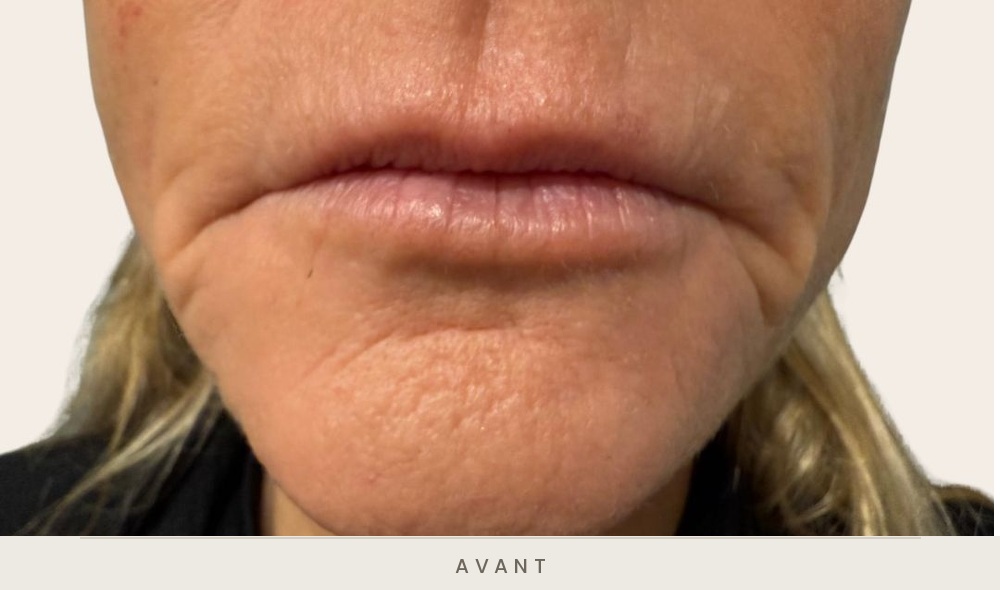 Injection d'acide hyaluronique des sillons nasogéniens et des plis d'amertume, vue de face avant l'injection — Dr David Ganon, chirurgien plasticien à Paris