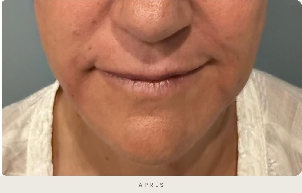 Injection d'acide hyaluronique des sillons nasogéniens et des plis d'amertume, vue de face après l'injection — Dr David Ganon, chirurgien plasticien à Paris