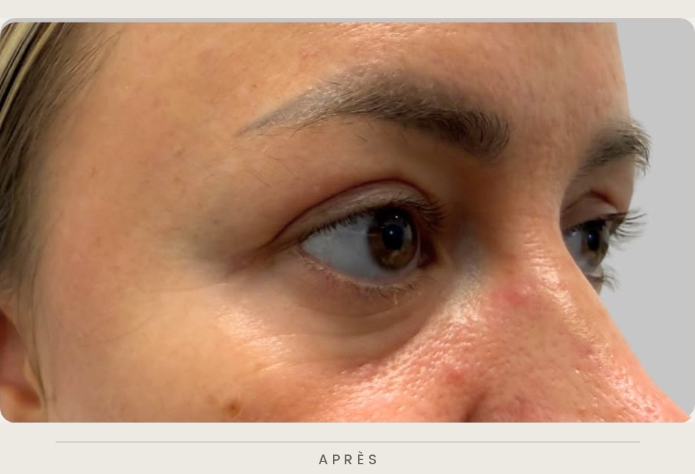 Blépharoplastie supérieure, vue de trois quarts après l'intervention — Dr David Ganon, chirurgien plasticien à Paris