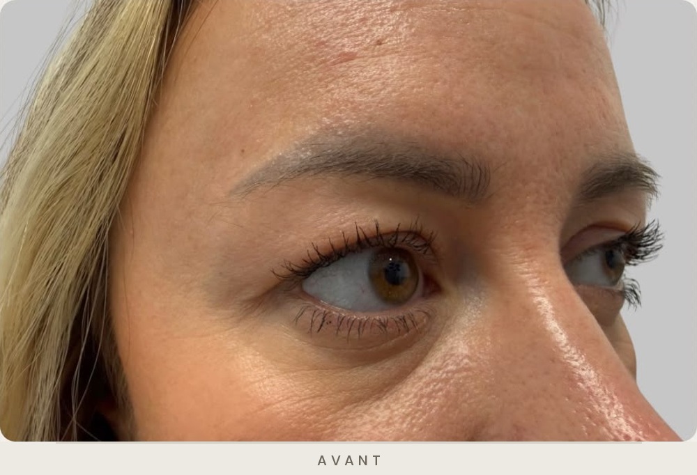 Blépharoplastie supérieure, vue de trois quarts avant l'intervention — Dr David Ganon, chirurgien plasticien à Paris