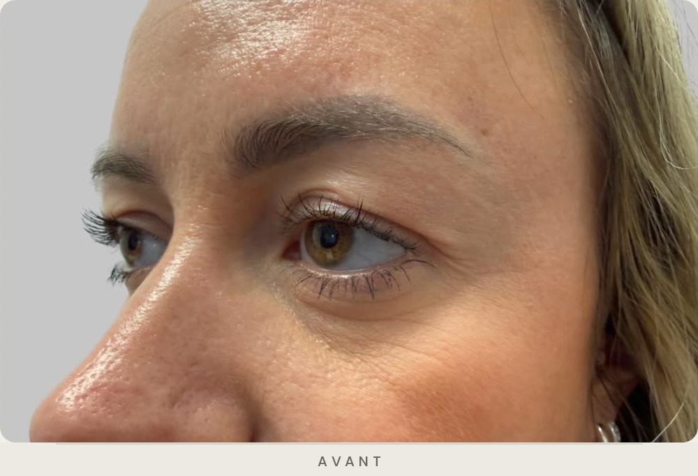 Blépharoplastie supérieure, vue de trois quarts avant l'intervention — Dr David Ganon, chirurgien plasticien à Paris
