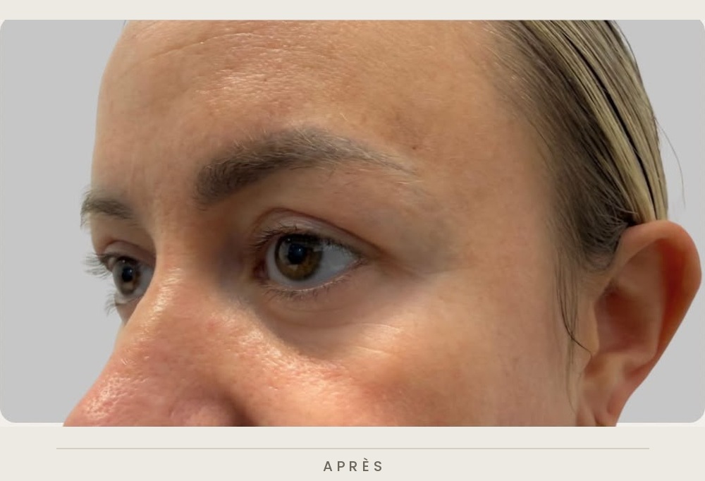 Blépharoplastie supérieure, vue de trois quarts après l'intervention — Dr David Ganon, chirurgien plasticien à Paris