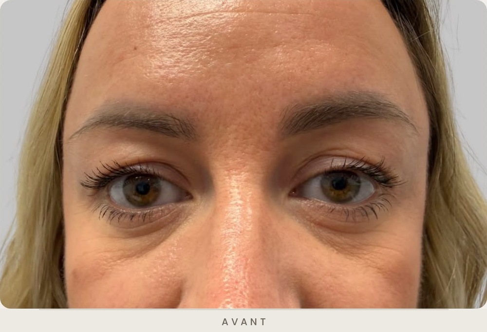 Blépharoplastie supérieure, vue de face avant l'intervention — Dr David Ganon, chirurgien plasticien à Paris