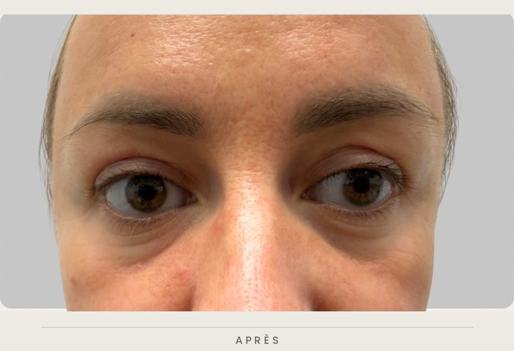 Blépharoplastie supérieure, vue de face après l'intervention — Dr David Ganon, chirurgien plasticien à Paris