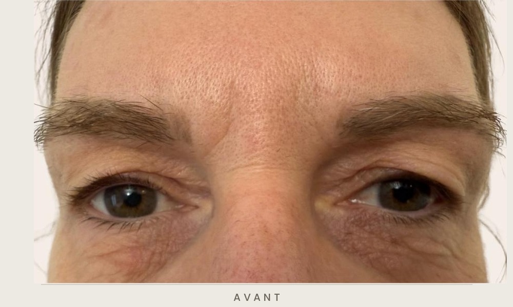 Blépharoplastie supérieure, vue de face avant l'intervention — Dr David Ganon, chirurgien plasticien à Paris