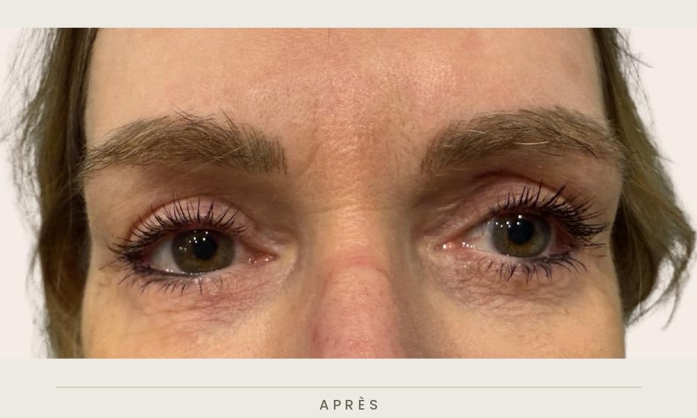 Blépharoplastie supérieure, vue de face après l'intervention — Dr David Ganon, chirurgien plasticien à Paris