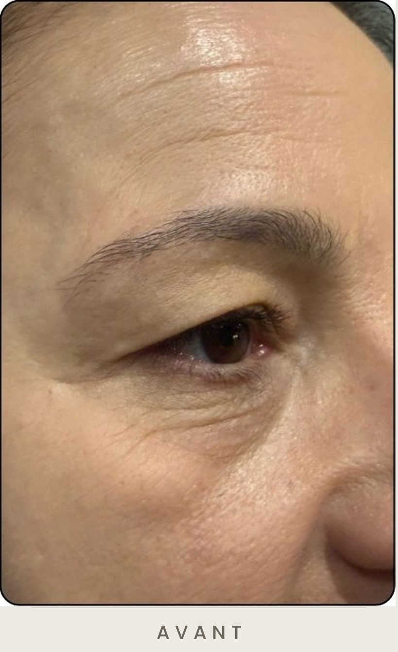 Blépharoplastie supérieure, vue de trois quarts avant l'intervention — Dr David Ganon, chirurgien plasticien à Paris