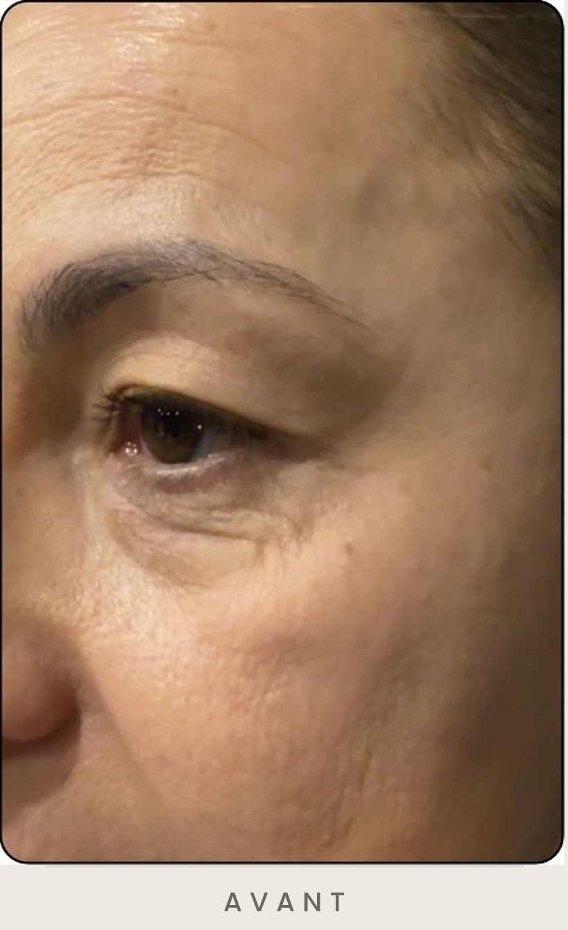 Blépharoplastie supérieure, vue de trois quarts avant l'intervention — Dr David Ganon, chirurgien plasticien à Paris