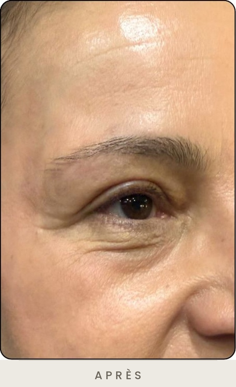 Blépharoplastie supérieure, vue de trois quarts après l'intervention — Dr David Ganon, chirurgien plasticien à Paris