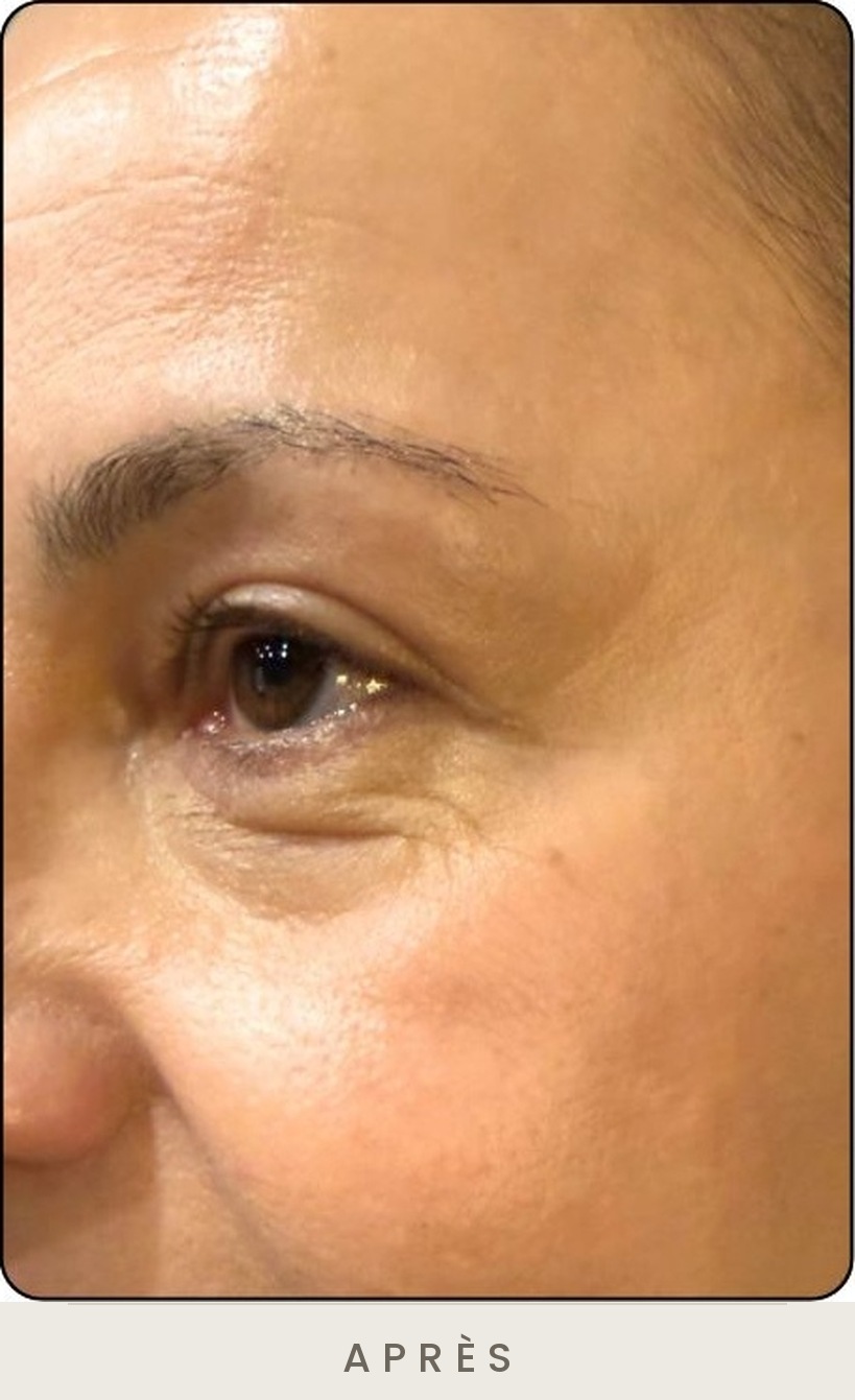 Blépharoplastie supérieure, vue de trois quarts après l'intervention — Dr David Ganon, chirurgien plasticien à Paris