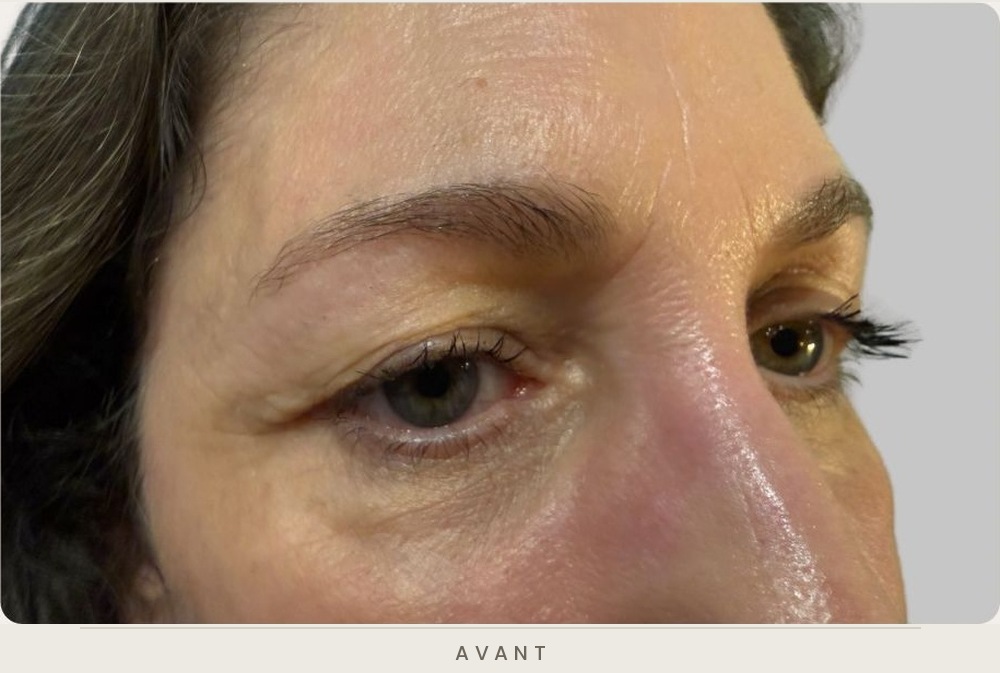 Blépharoplastie supérieure, vue de trois quarts avant l'intervention — Dr David Ganon, chirurgien plasticien à Paris
