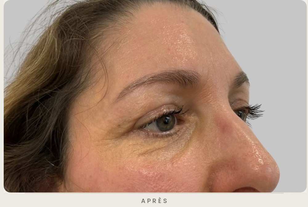 Blépharoplastie supérieure, vue de trois quarts après l'intervention — Dr David Ganon, chirurgien plasticien à Paris
