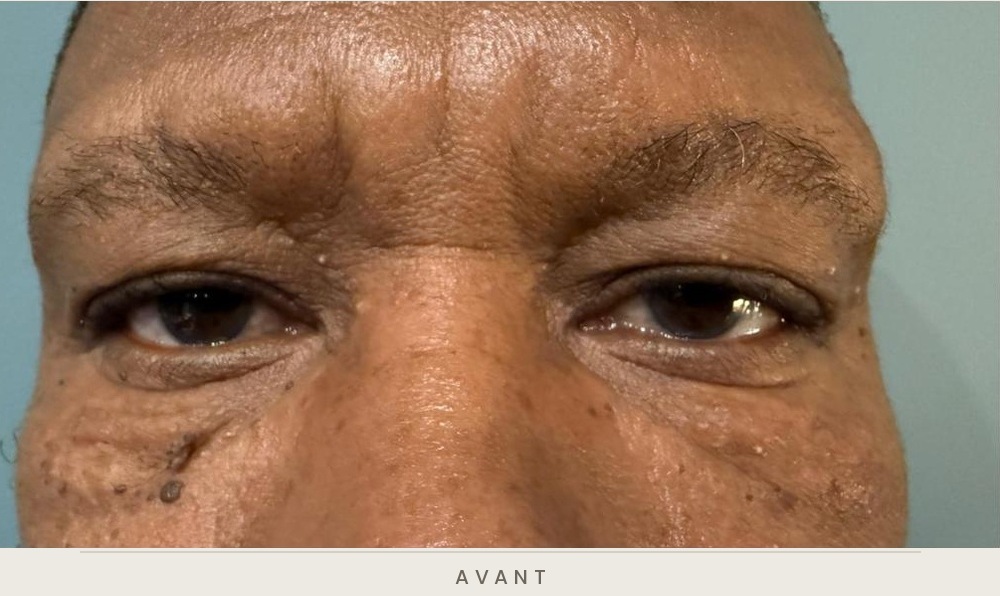 Blépharoplastie supérieure, vue de face avant l'intervention — Dr David Ganon, chirurgien plasticien à Paris