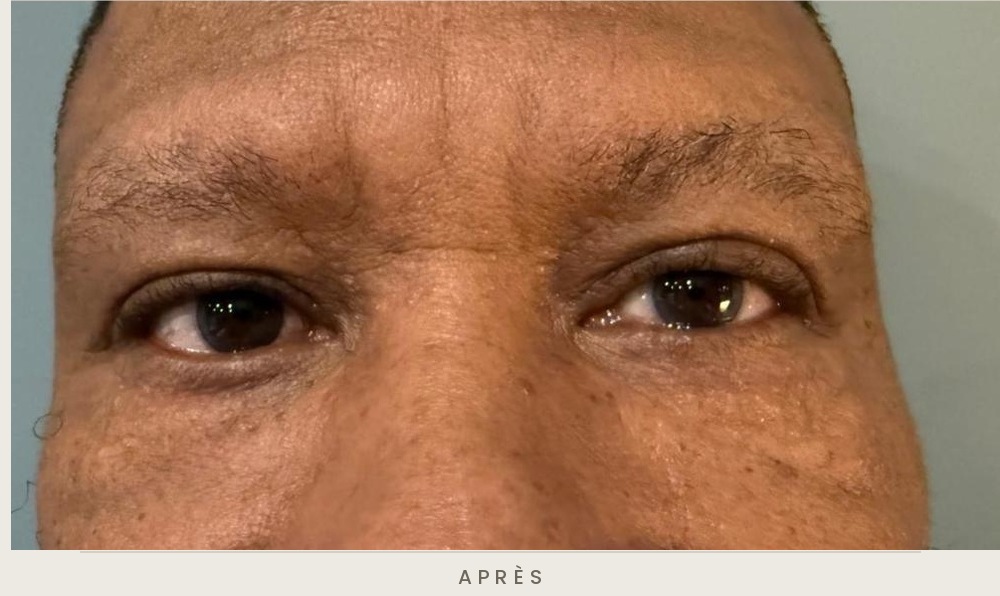 Blépharoplastie supérieure, vue de face après l'intervention — Dr David Ganon, chirurgien plasticien à Paris