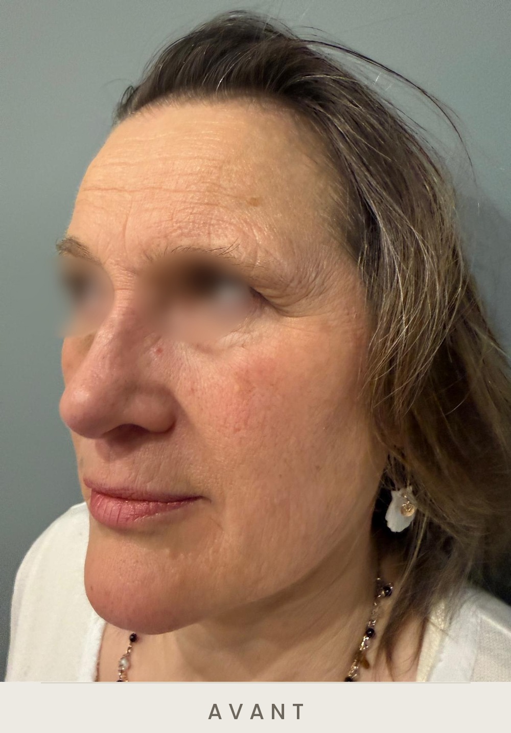 Injection de botox (toxine botulique), rides du front, trois quarts gauche avant l'injection — Dr David Ganon, chirurgien plasticien à Paris