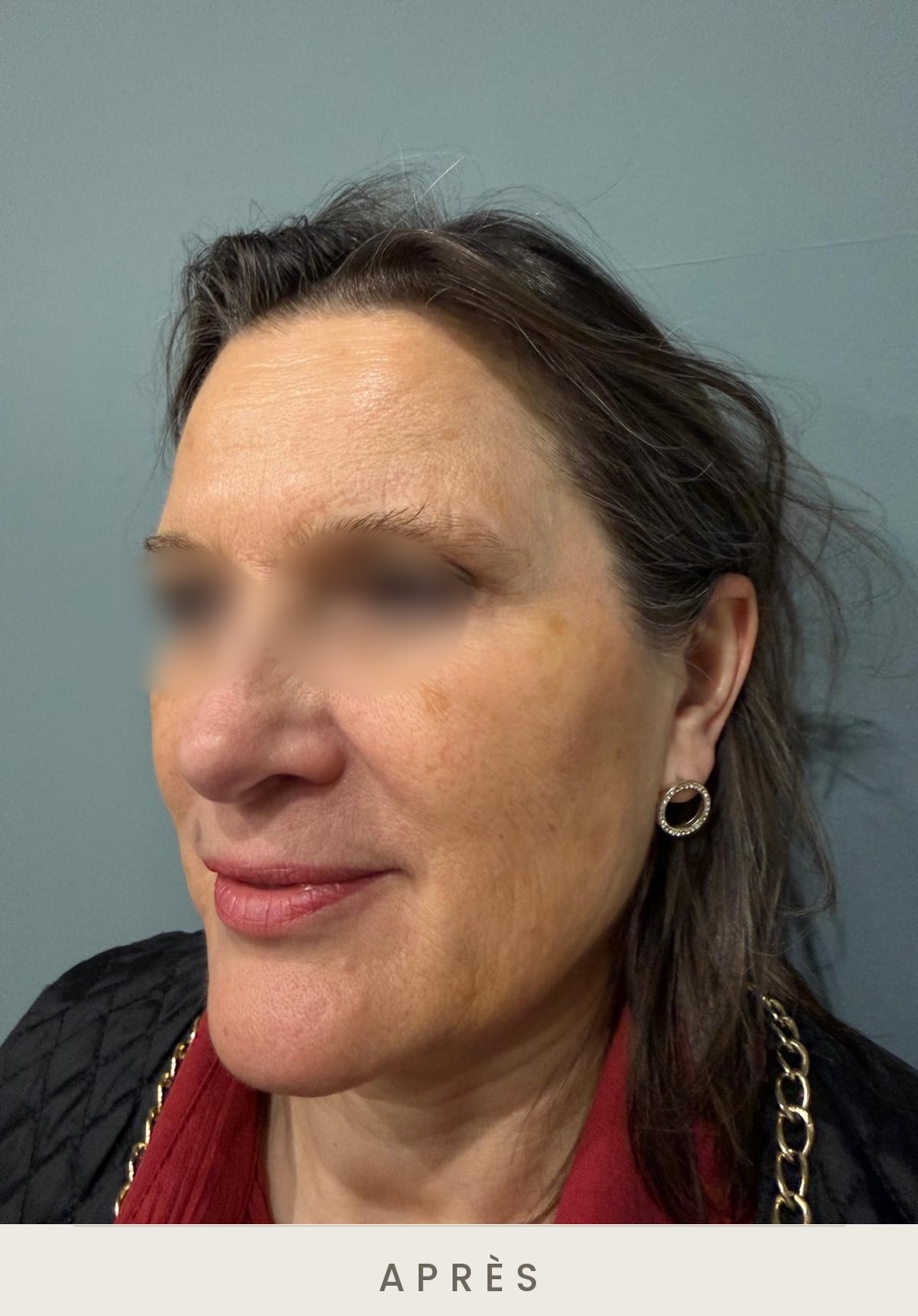 Injection de botox (toxine botulique), rides du front, trois quarts gauche après l'injection — Dr David Ganon, chirurgien plasticien à Paris