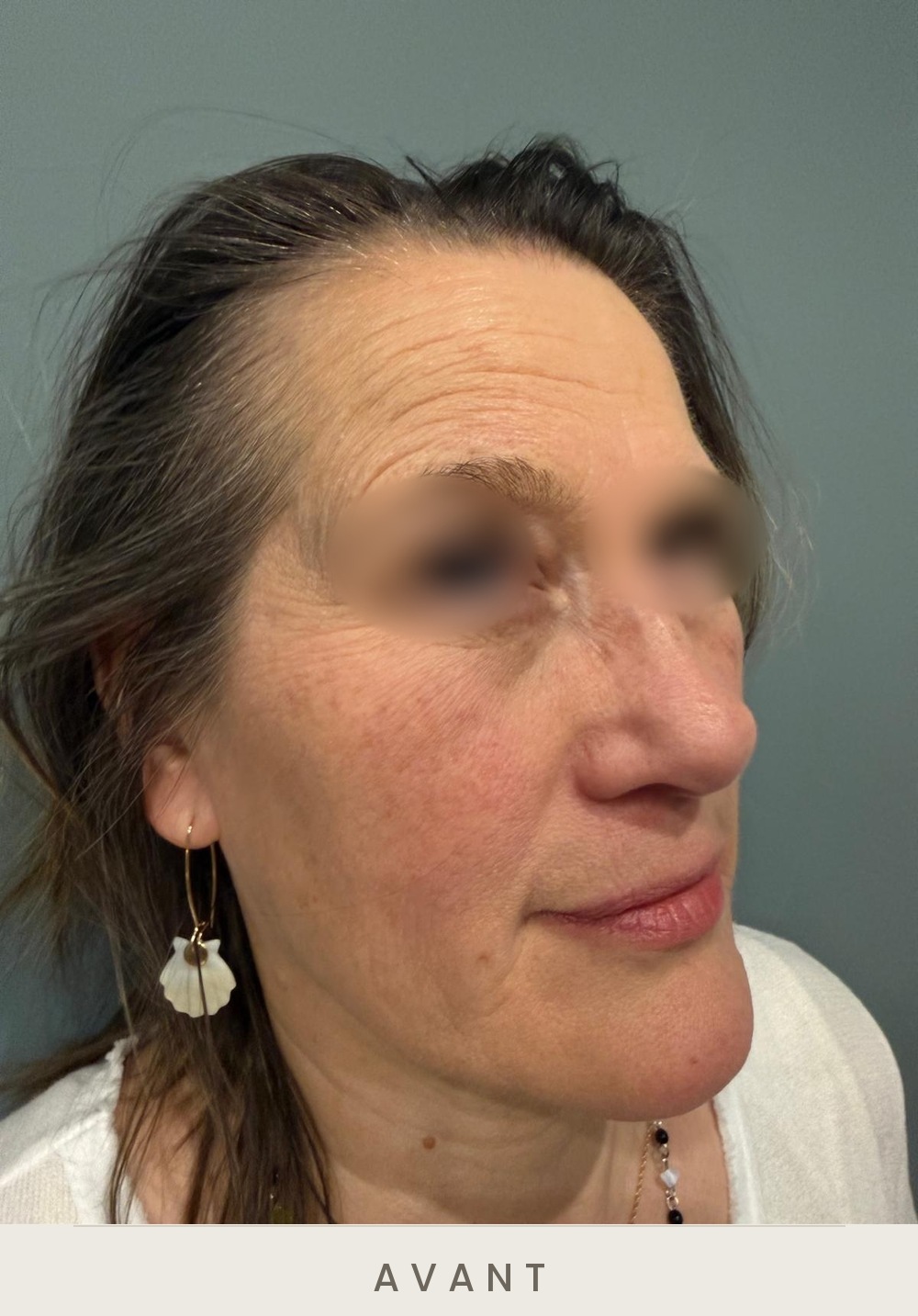 Injection de botox (toxine botulique), rides du front, trois quarts droit avant l'injection — Dr David Ganon, chirurgien plasticien à Paris