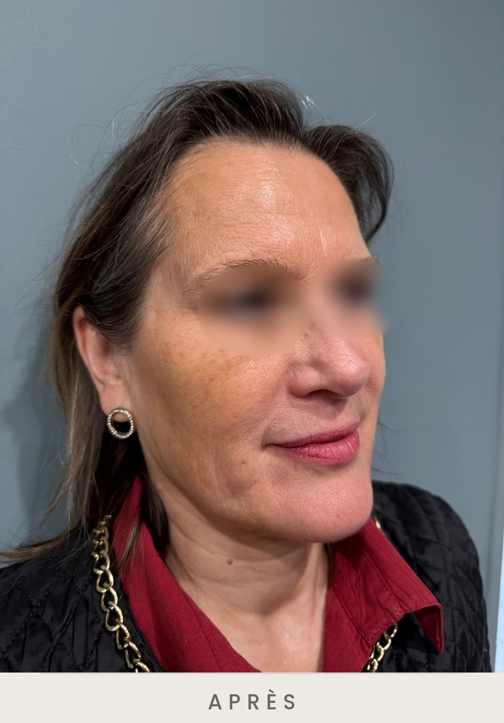 Injection de botox (toxine botulique), rides du front, trois quarts droit après l'injection — Dr David Ganon, chirurgien plasticien à Paris