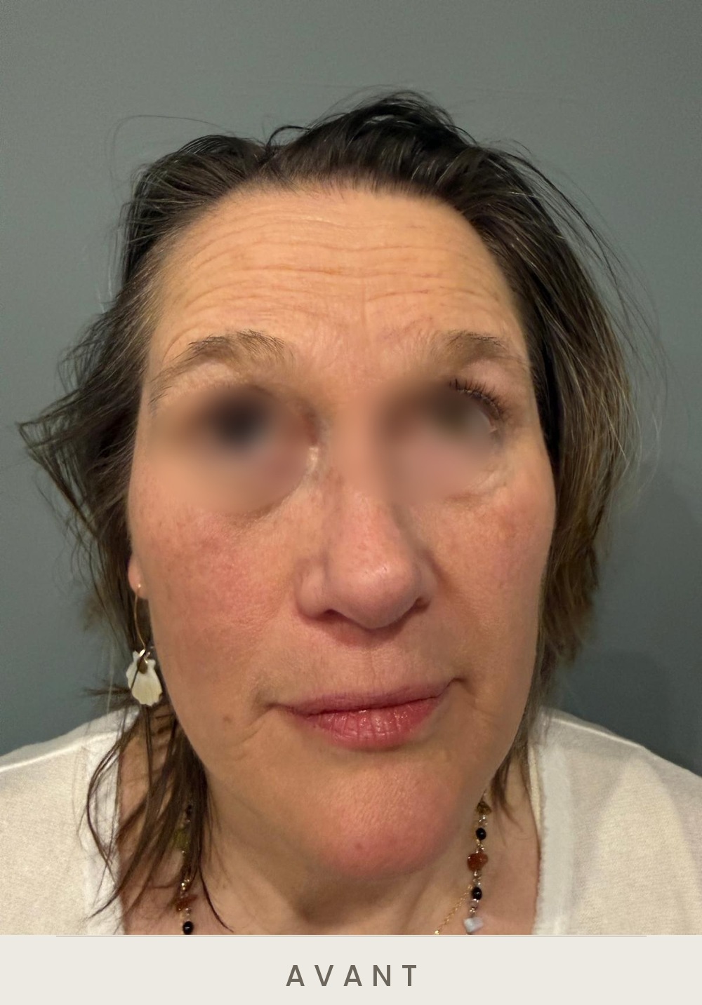 Injection de botox (toxine botulique), rides du front, vue de face avant l'injection — Dr David Ganon, chirurgien plasticien à Paris