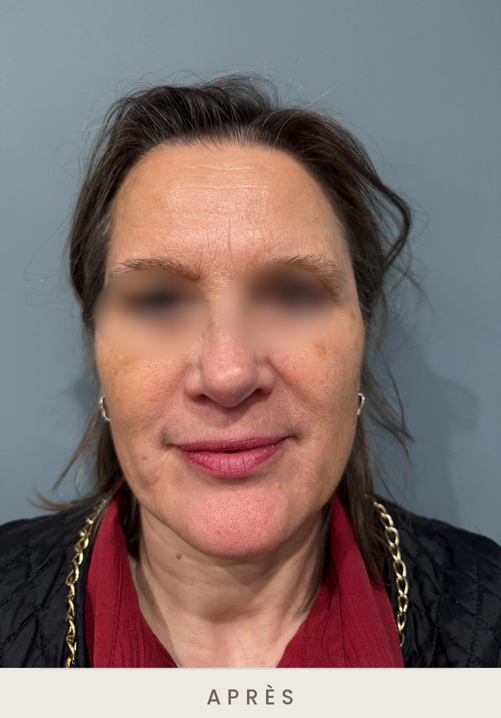 Injection de botox (toxine botulique), rides du front, vue de face après l'injection — Dr David Ganon, chirurgien plasticien à Paris
