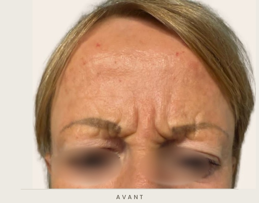 Injection de toxine botulique, rides du front et de la glabelle, vue de face avant l'injection — Dr David Ganon, chirurgien plasticien à Paris