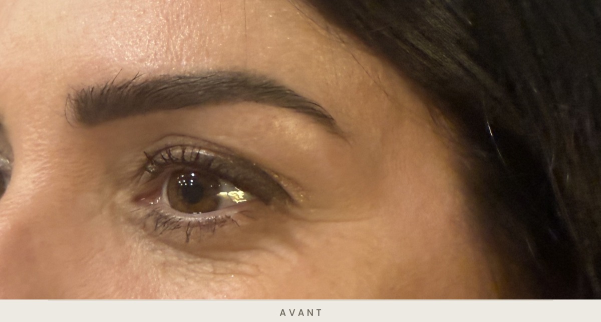 Blépharoplastie supérieure, vue de trois quarts avant l'intervention — Dr David Ganon, chirurgien plasticien à Paris