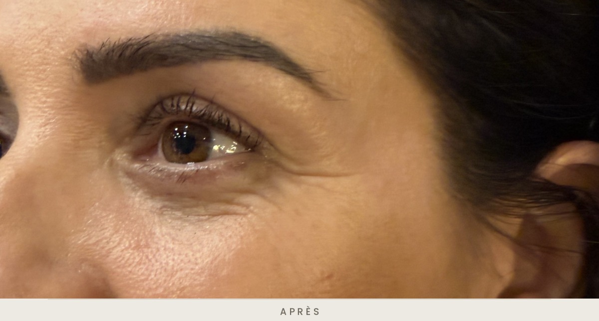 Blépharoplastie supérieure, vue de trois quarts après l'intervention — Dr David Ganon, chirurgien plasticien à Paris