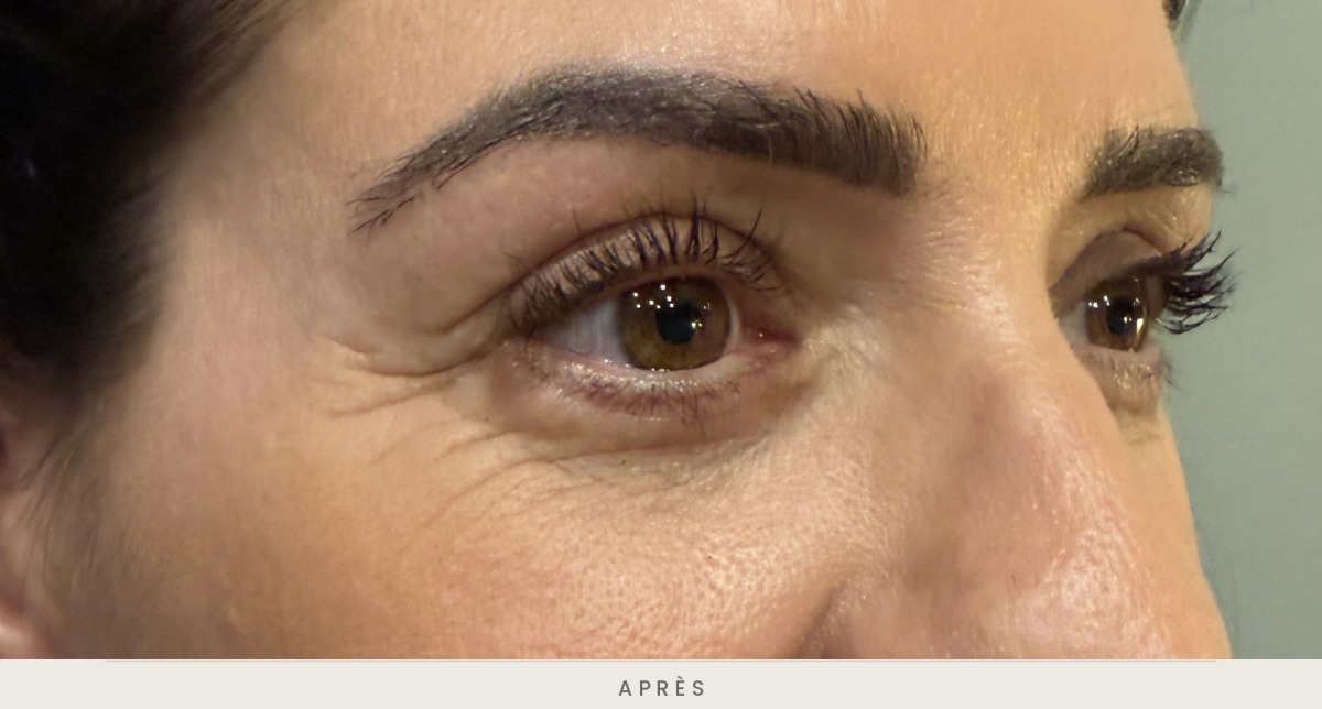 Blépharoplastie supérieure, vue de trois quarts après l'intervention — Dr David Ganon, chirurgien plasticien à Paris