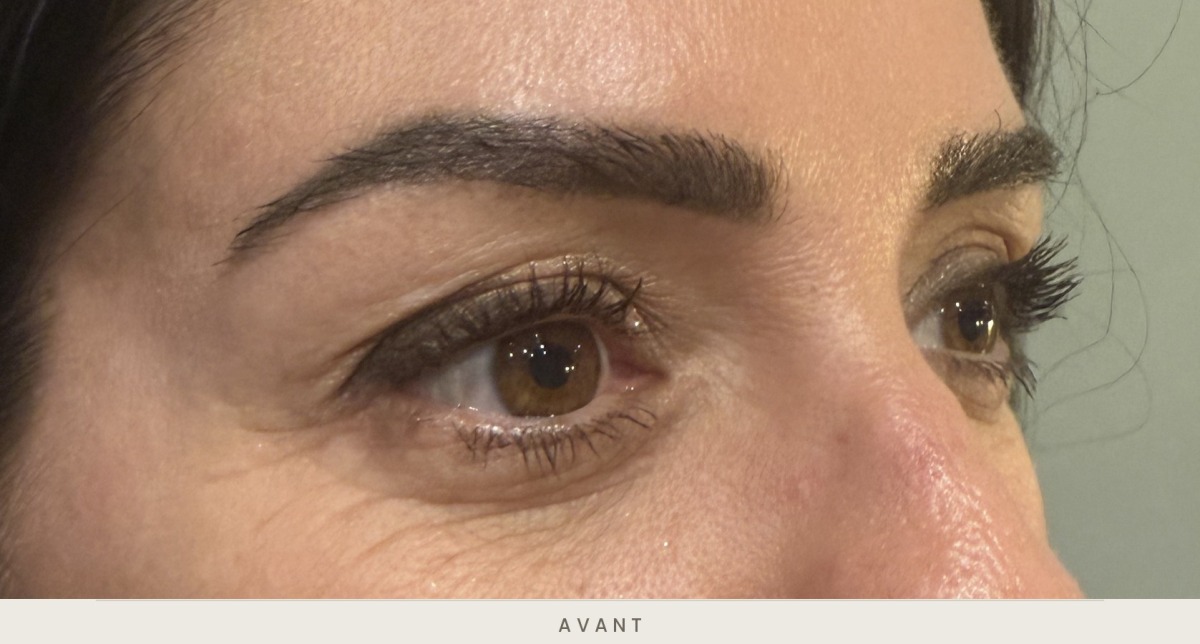 Blépharoplastie supérieure, vue de trois quarts avant l'intervention — Dr David Ganon, chirurgien plasticien à Paris