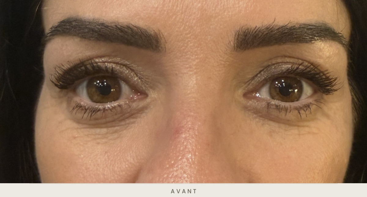 Blépharoplastie supérieure, vue de face avant l'intervention — Dr David Ganon, chirurgien plasticien à Paris