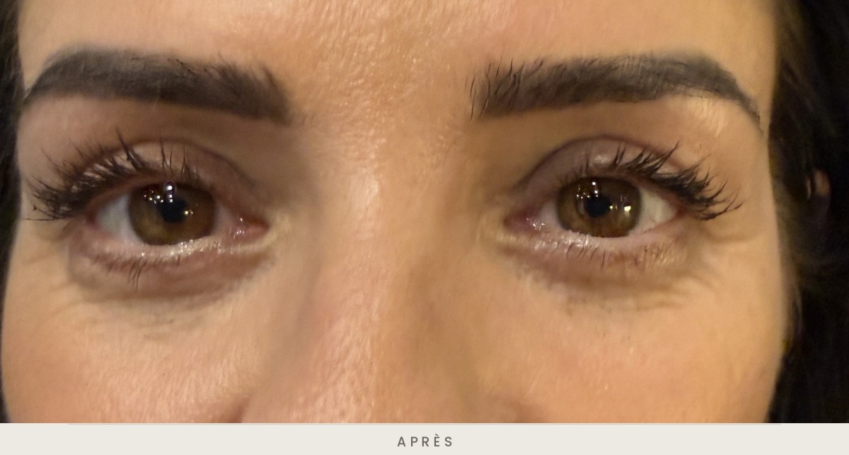 Blépharoplastie supérieure, vue de face après l'intervention — Dr David Ganon, chirurgien plasticien à Paris