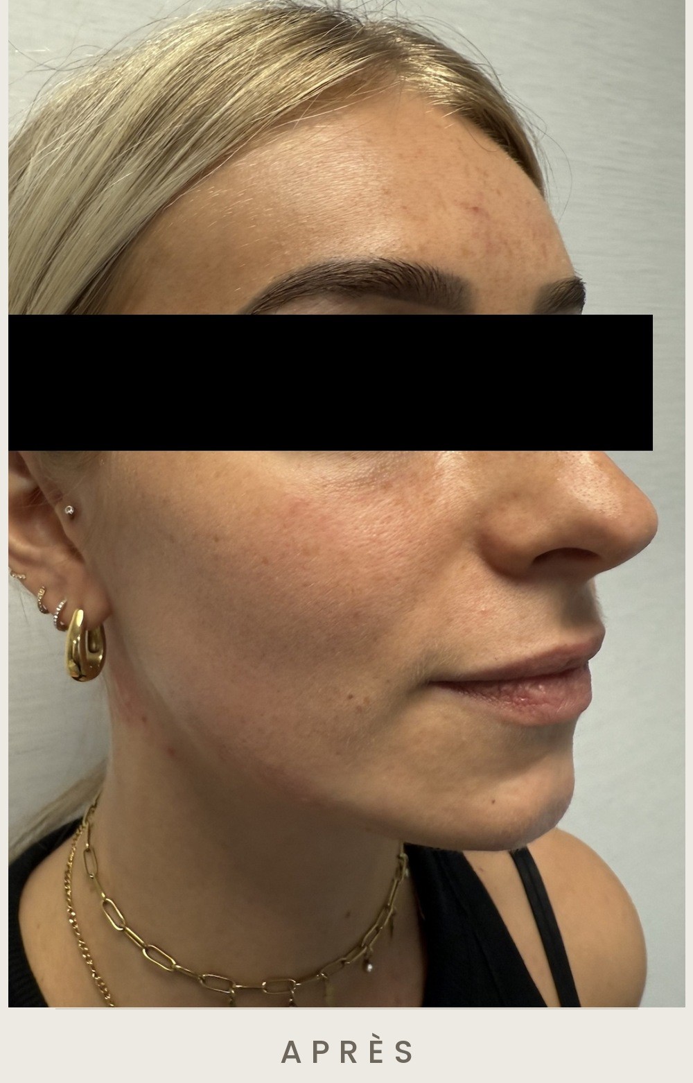 Contour mandibulaire (jawline) à l'acide hyaluronique, trois quarts droit après l'injection — Dr David Ganon, chirurgien plasticien à Paris