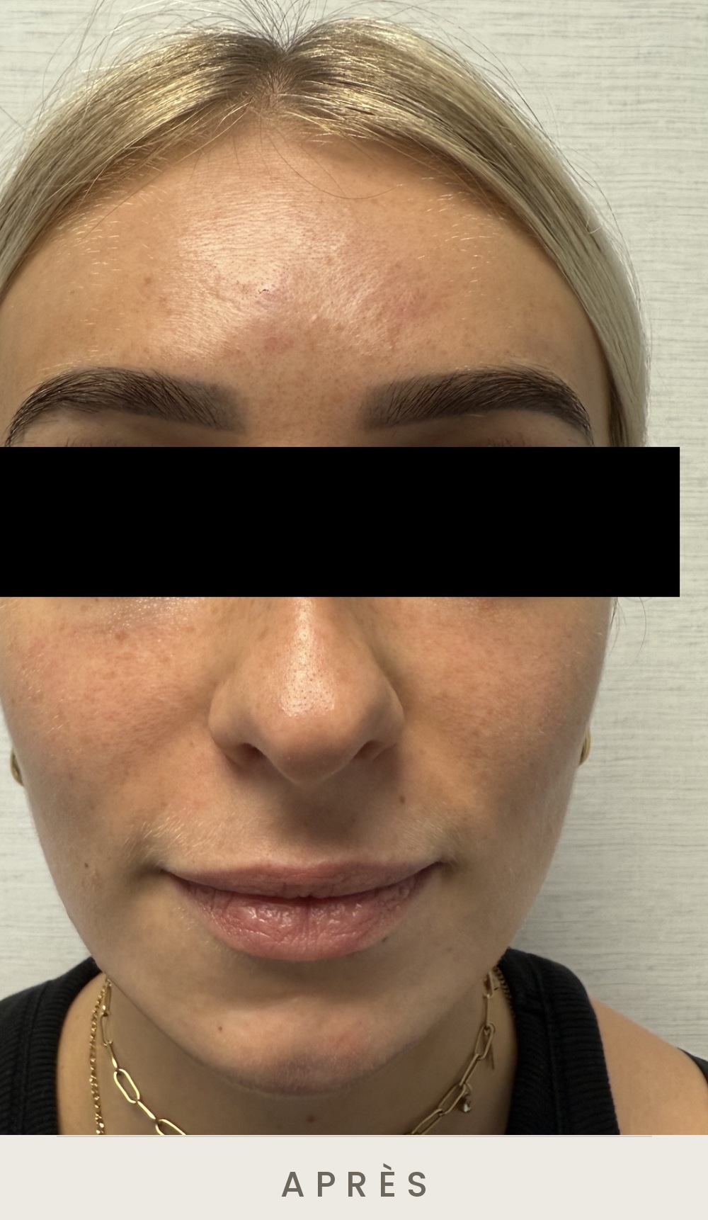 Contour mandibulaire (jawline) à l'acide hyaluronique, vue de face après l'injection — Dr David Ganon, chirurgien plasticien à Paris