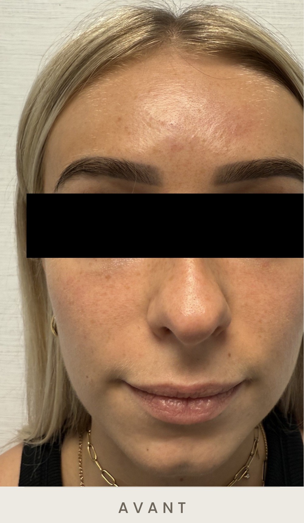 Contour mandibulaire (jawline) à l'acide hyaluronique, vue de face avant l'injection — Dr David Ganon, chirurgien plasticien à Paris