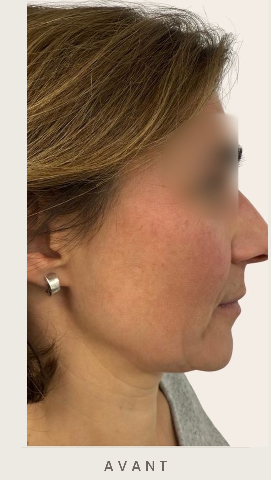 Traitement de l'ovale du visage à l'acide hyaluronique, profil avant le traitement — Dr David Ganon, chirurgien plasticien à Paris
