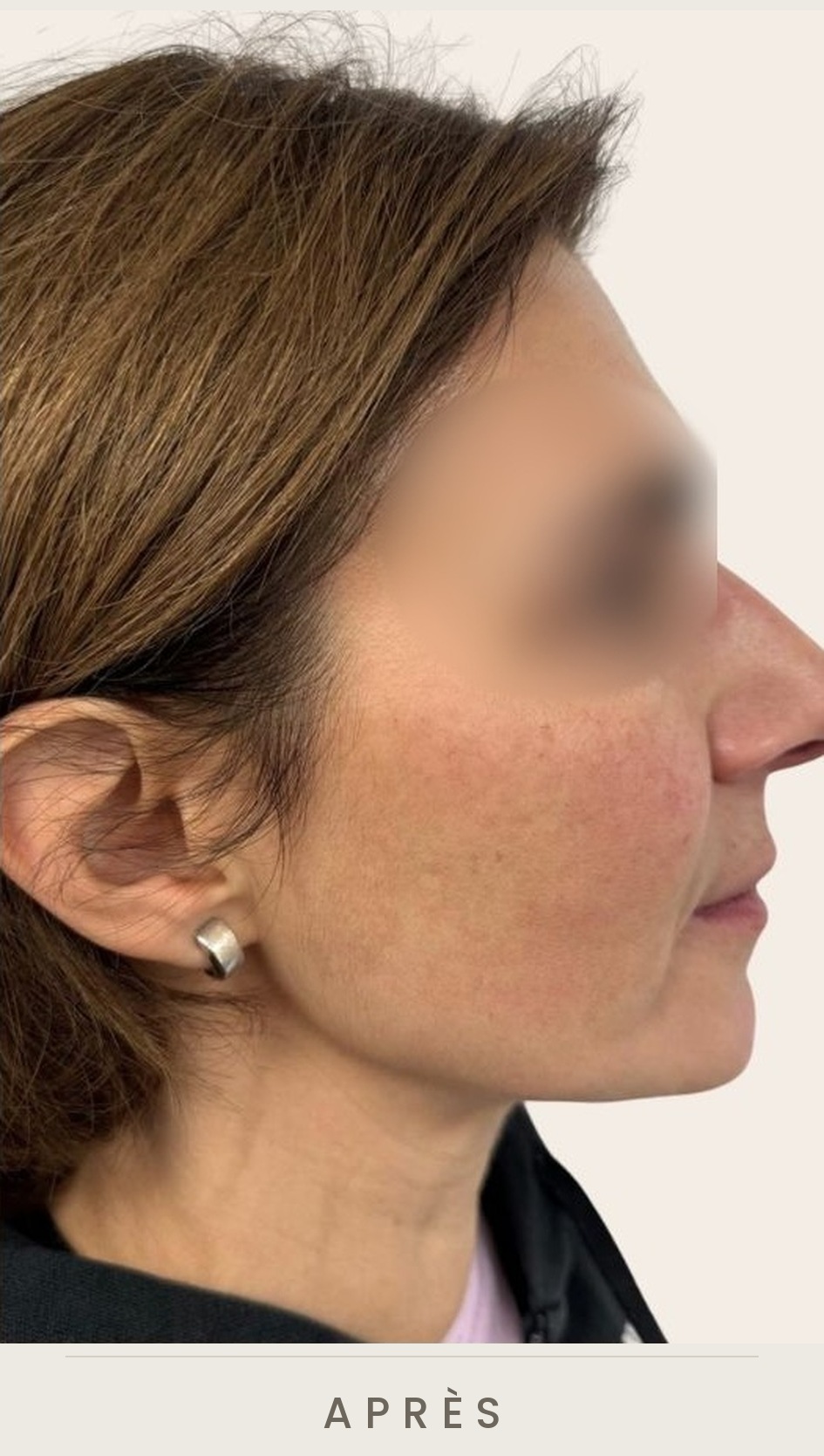 Traitement de l'ovale du visage à l'acide hyaluronique, profil après le traitement — Dr David Ganon, chirurgien plasticien à Paris