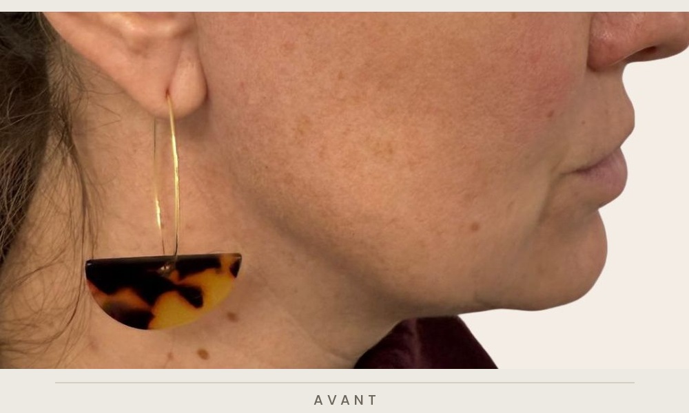 Traitement de l'ovale du visage et des sillons nasogéniens à l'acide hyaluronique, profil droit avant l'injection — Dr David Ganon, chirurgien plasticien à Paris