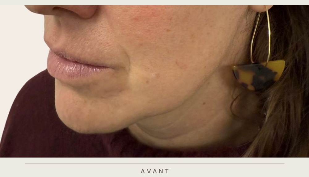 Traitement de l'ovale du visage et des sillons nasogéniens à l'acide hyaluronique, trois quarts droit avant l'injection — Dr David Ganon, chirurgien plasticien à Paris