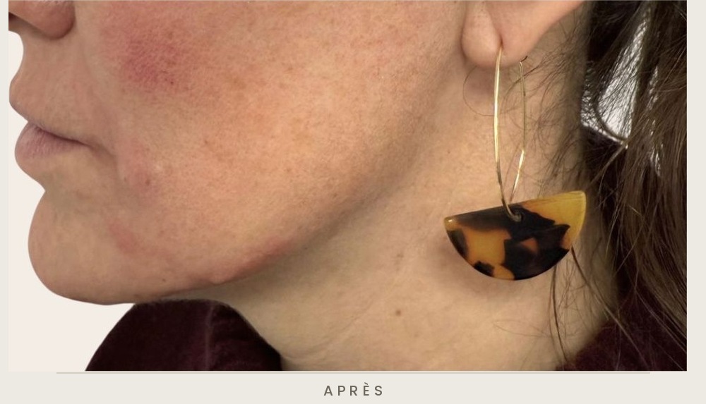 Traitement de l'ovale du visage et des sillons nasogéniens à l'acide hyaluronique, trois quarts droit après l'injection — Dr David Ganon, chirurgien plasticien à Paris