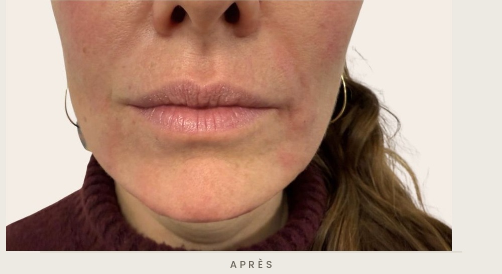 Traitement de l'ovale du visage et des sillons nasogéniens à l'acide hyaluronique, vue de face après l'injection — Dr David Ganon, chirurgien plasticien à Paris
