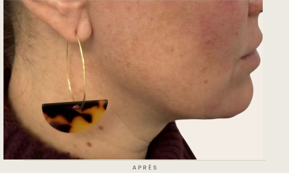 Traitement de l'ovale du visage et des sillons nasogéniens à l'acide hyaluronique, profil droit après l'injection — Dr David Ganon, chirurgien plasticien à Paris