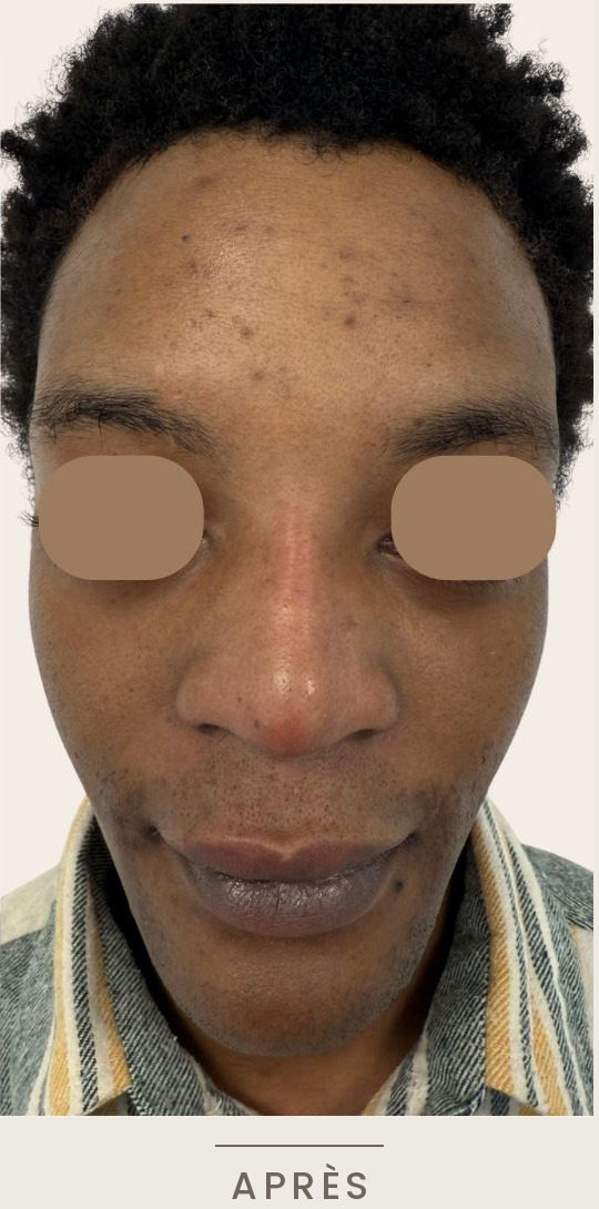 Rhinoplastie médicale à l'acide hyaluronique, vue de face après l'intervention — Dr David Ganon, chirurgien plasticien à Paris