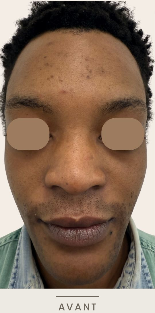 Rhinoplastie médicale à l'acide hyaluronique, vue de face avant l'intervention — Dr David Ganon, chirurgien plasticien à Paris