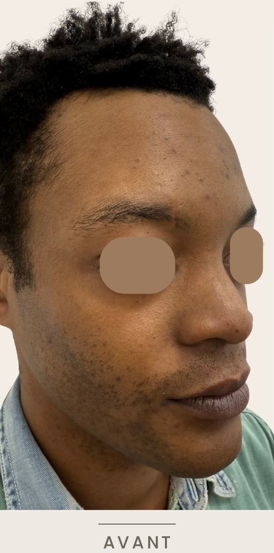 Rhinoplastie médicale à l'acide hyaluronique, vue de trois quarts droit avant l'intervention — Dr David Ganon, chirurgien plasticien à Paris