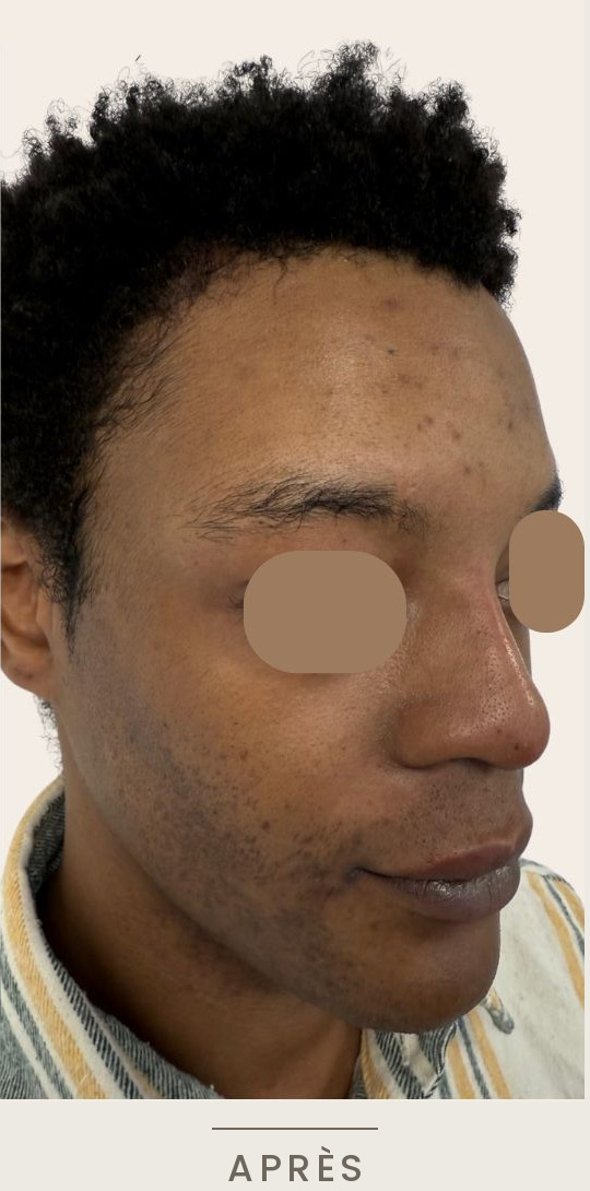 Rhinoplastie médicale à l'acide hyaluronique, vue de trois quarts droit après l'intervention — Dr David Ganon, chirurgien plasticien à Paris